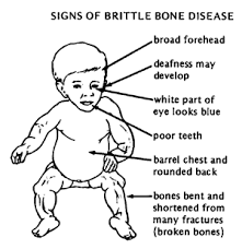 brittle bone
